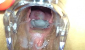 Creampie Speculum